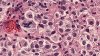 Ensayos clínicos de vacuna logran resultados alentadores en la lucha contra el cáncer de piel más letal