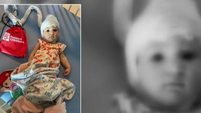 Niña hispana sufre una extraña condición que limita el desarrollo de su cerebro