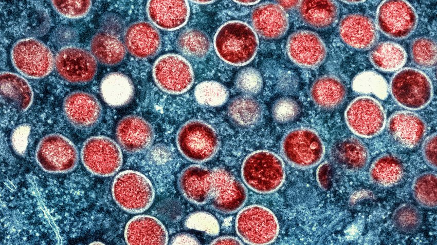 FILE – This undated image provided by the National Institute of Allergy and Infectious Diseases shows a colorized transmission electron micrograph of monkeypox particles (red) found within an infected cell (blue), cultured in the laboratory that was captured and color-enhanced at the NIAID Integrated Research Facility in Fort Detrick, Md.