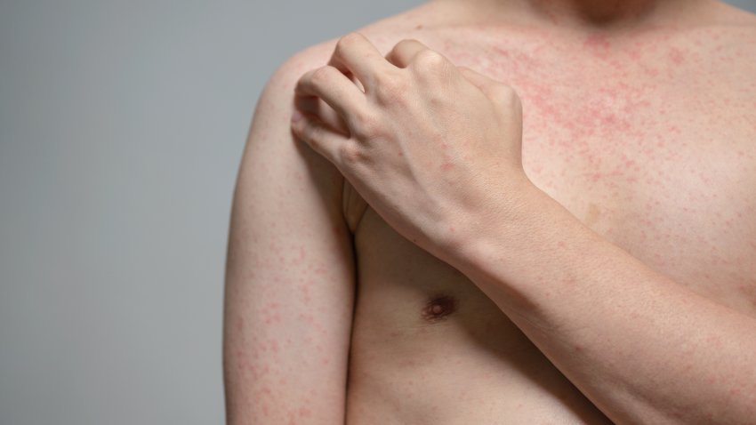 Dermatitis rash viral disease with immunodeficiency on body of young adult asian, scratching with itching, Measles Virus, Viral Exanthem